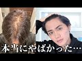 【初公開】薄毛アンチコメが酷すぎるので本当にAGA治療始めます。