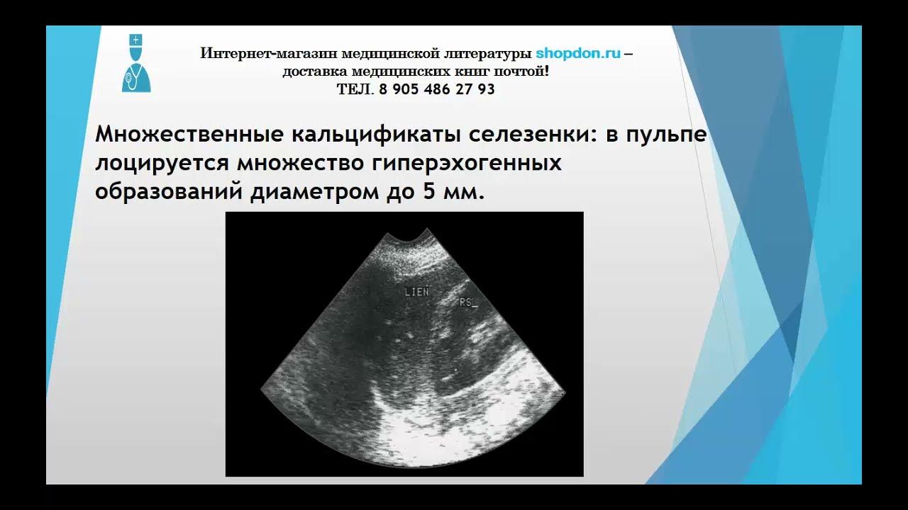 Образование в селезенке что это. Образование в селезенке что это. Белая пульпа селезенки гистология. Добавочная долька селезенки мрт. Узи селезенки.