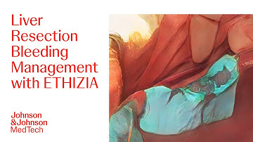 Control Bleeding with ETHIZIA Hemostatic Sealing Patch in Liver Resection Surgery | J&J MedTech