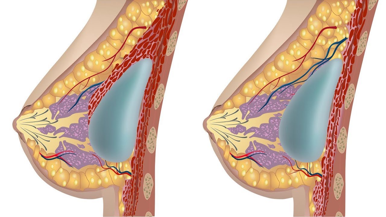 Huge Breast Implants Tumblr