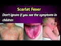Scarlet Fever Symptoms and Treatment.