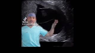 Monochorionic Diamnionic Ultrasound