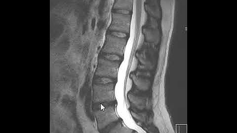 How to Read an MRI Scan of the Lumbar Spine | First Look MRI