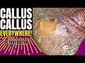 Callus Callus Everywhere: Trimming Extreme Callus Buildup On Feet