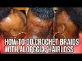 Top key things to know when installing crochet braids with alopecia