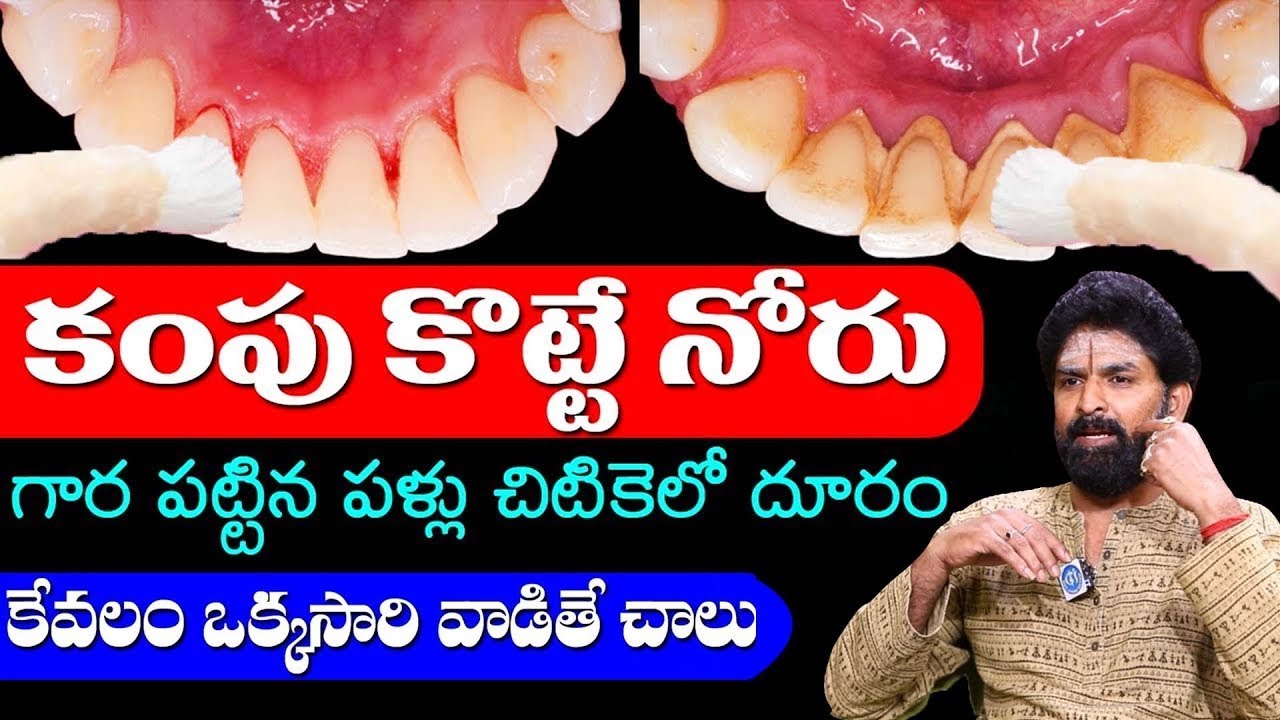 కంపుకొట్టే నోరు గార పట్టిన పళ్ళు చిటికెలో పోగొట్టే టిప్ | Bad Smell From Mouth Tips | Vikram Aditya