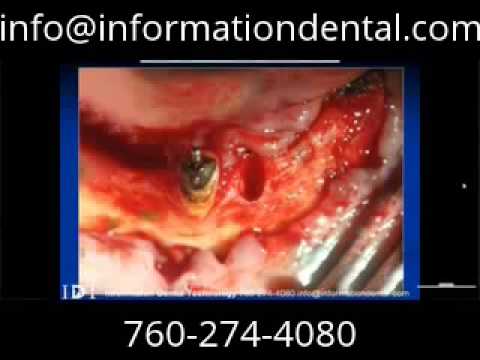 Bone Supported Surgical Guide