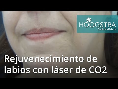 Video: Procedimiento De La Semana: Peeling Brillante Y Rejuvenecimiento De Labios Con Láser
