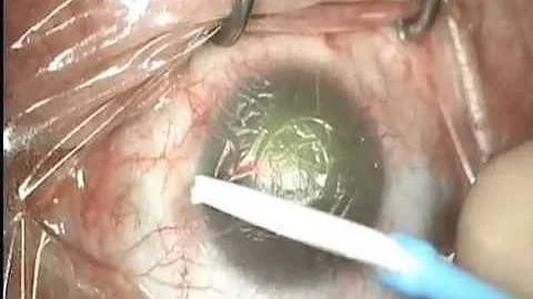 AmbioDisk - Kathryn Hatch, M.D.