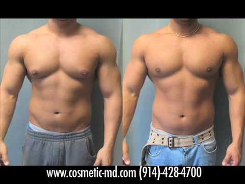 on gynecomastia patients from the austin san antonio gynecomastia surgery cost