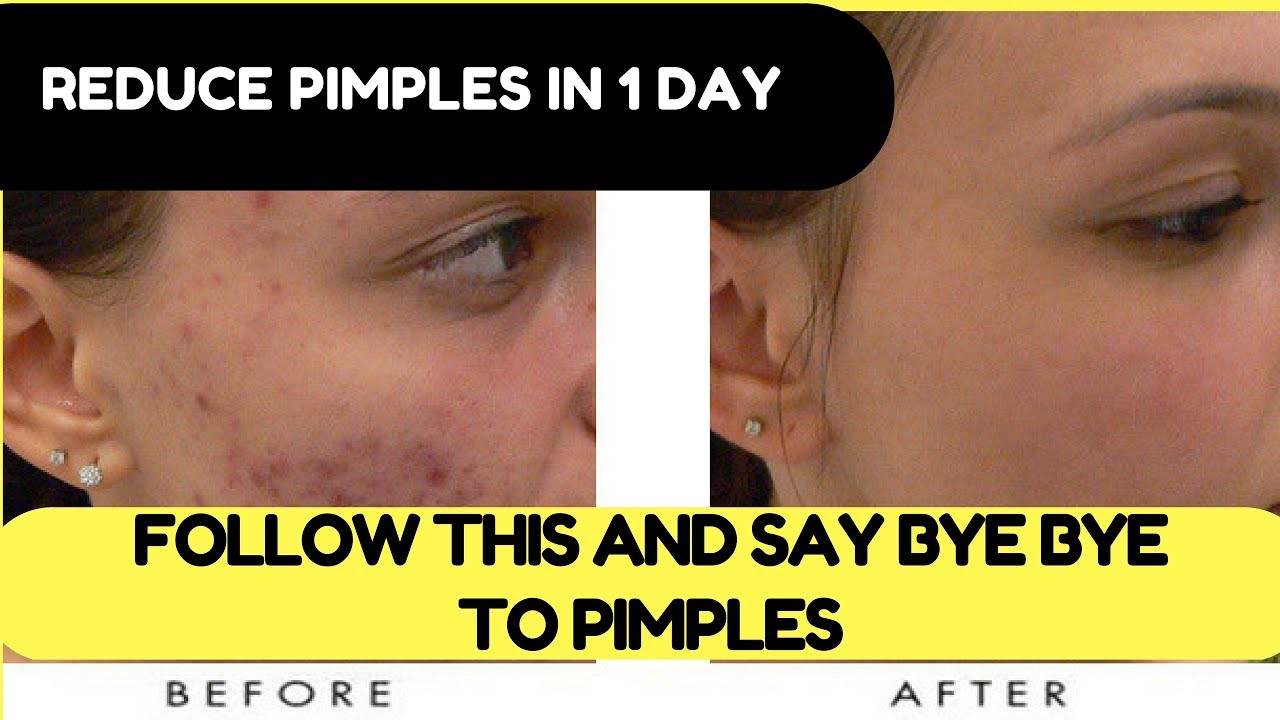 Remove Pimples in 1 day 100% Effective| Homemade Pimple Remover For Men and Women. - YouTube