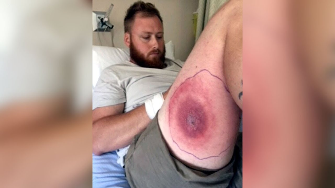 N S Man Recovering From Suspected Brown Recluse Spider Bite Youtube