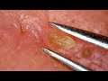 0288 keratin plug removal nose