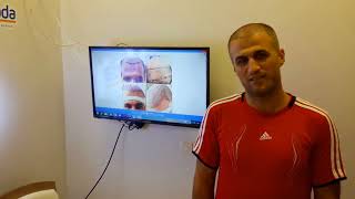 Adana Saç Ekimi Hasta Yorumları - Este Moda Hair Saç Ekimi Merkezi