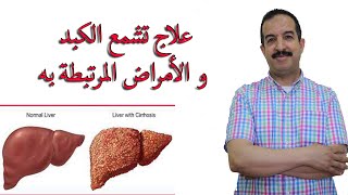 علاج تشمع الكبد و الامراض المرتبطة به