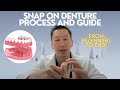 Snap on denture steps