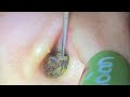 ASMR耳掃除: 溜まりに溜まった耳垢がスルリ!プロの確かな技術と繊細な音で究極の安らぎ👂💫
