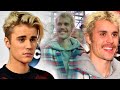 Toda la verdad detrás de la enfermedad incurable de Justin Bieber