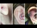 How do I get rid of a Keloid / hypertrophic scar aka piercing bump