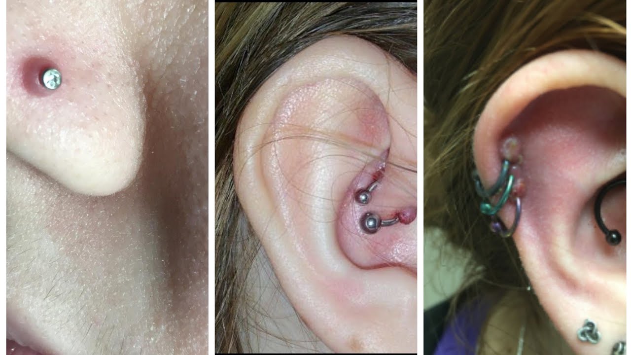 To solve the scarring of Piercekeloid