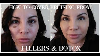 HOW TO COVER BRUISING FROM FILLERS & BOTOX
