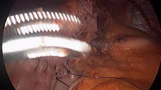 MIDCAL ™ Ring Placement on the Gastric Pouch during R-Y Gastric Bypass Surgery.