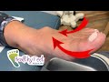 LARGEST CYST IN FOOT DOCTOR HAS EVER SEEN