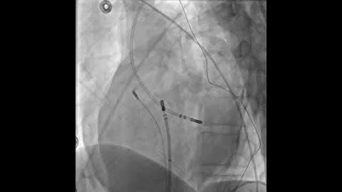 Hands-On Ablation - Video 34.4