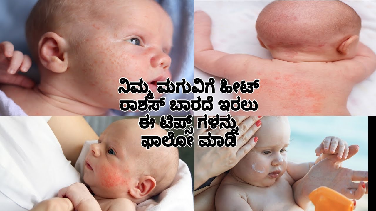 ಬಿಸಿಲಿಗೆ ನಿಮ್ಮ ಮಗುವಿಗೂ ಹೀಗಾಗುತ್ತಿದೆಯಾ? ಹಾಗಿದ್ದರೆ ಈ ಟಿಪ್ಸ್ ಫಾಲೋ ಮಾಡಿ ...
