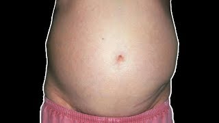 What is Ascites Fluid And How to Get Rid of Ascites In the Abdomen?