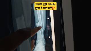 पैर की पतली और लंबी हड्डी Fibula फिबुला टूटने पे क्या करें💥Fibula Fracture Treatment #fibulafracture