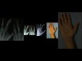 Cascade Sign Explained: Hand Fractures & Tendon Injuries | #shorts #meded #handpain #orthopedics
