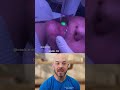 Laser Treatment for a Chin and Lip Port Wine Stain