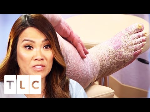 Treating The Most Extreme Case Of Scaly Skin! | Dr. Pimple Popper: This Is Zit