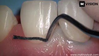 Dentistry. Impression with microscope. Teeth preparation for ceramic veneers.