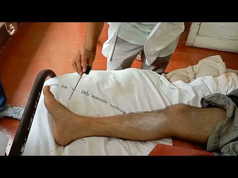 Bing's sign - alternative method to get plantar reflex here in this clip Babinski +ve