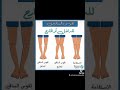 تقوس الساقين عند الأطفال والكبار