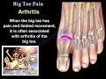 Big Toe Pain  - Everything You Need To Know - Dr. Nabil Ebraheim
