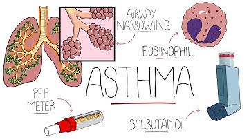 Asthma Explained (Including Pathophysiology)