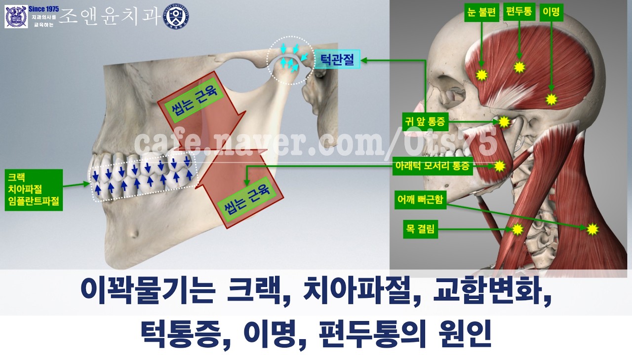 [내일남] 턱통증의 실체는 근육통증이 대부분이며 그 원인은 이꽉물기와 안 맞는 교합때문입니다. 턱관절 자체는 통증을 유발하지 않습는다 : 스플린트보다는 턱보톡스치료가 효과적인 이유