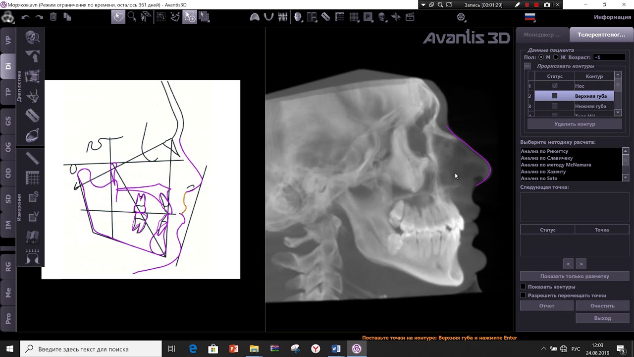 Трг программы. Программа для трг gamma. Анализ трг по славичеку. Трг программы. Телерентгенография в ортодонтии.