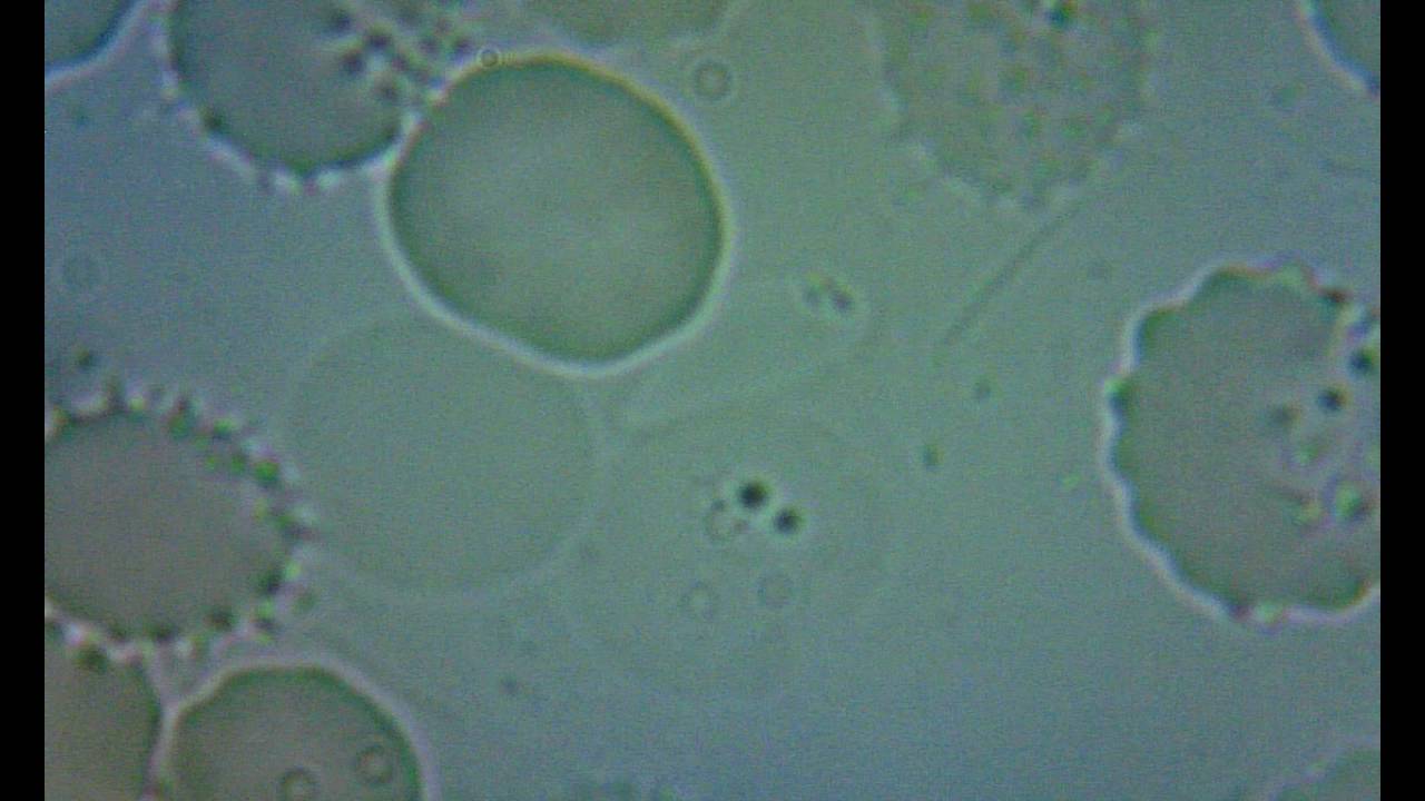 Lyme under the microscope 1 YouTube