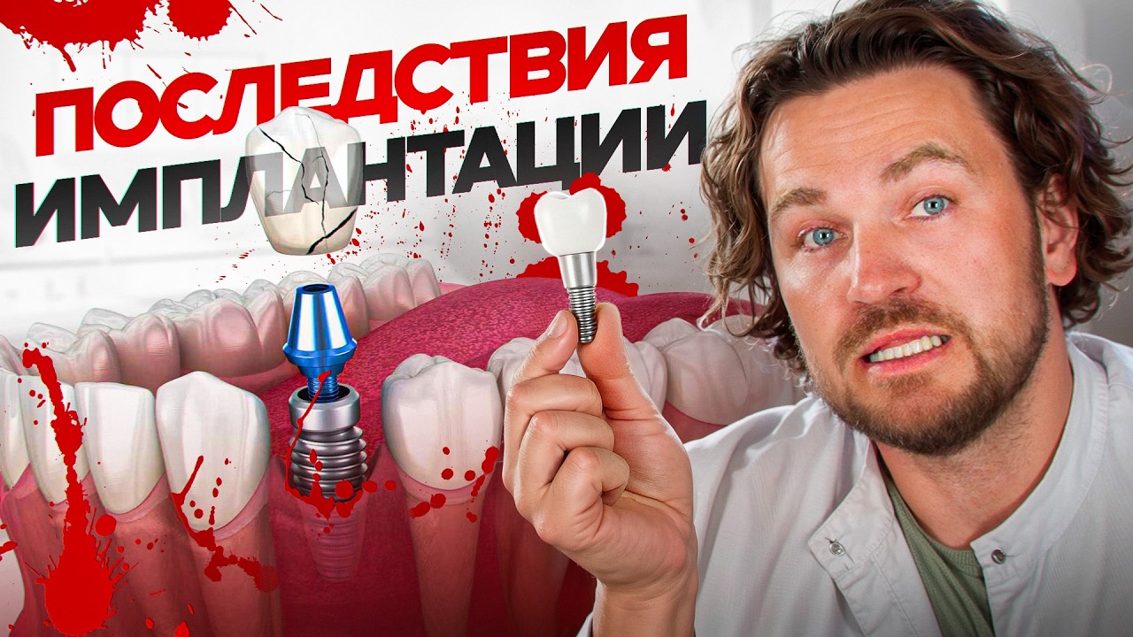 Самые распространенные ПРОБЛЕМЫ после имплантации зубов / Последствия имплантации и осложнения