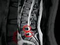 The "Disc Bulge" Myth: Why Your MRI Might Be Lying to You #shorts
