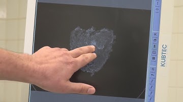 SSM Health Medical Minute - Tool for analyzing tissue during surgery