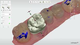 3.10 - 3Shape TRIOS Design Studio - Virtual Dynamic Articulator