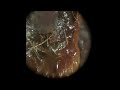 10 year old ear wax removal
