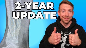 Tib/Fib Fracture 2-Year Recovery Update