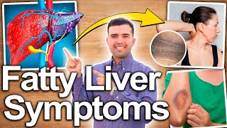 DONT IGNORE FATTY LIVER Symptoms You Need To Know About Before Its Too Late