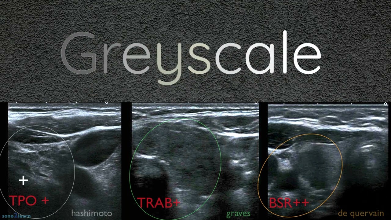 Differential-Diagnose der Thyreoiditis- Worauf soll ich achten?